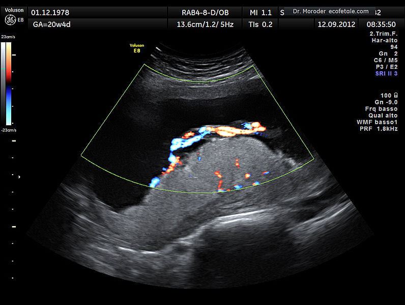 Reasons For Placental Infarction